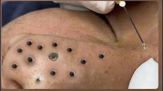 Cleaning Blackheads amp Whiteheads Satisfying Removal456 [upl. by Kennith]