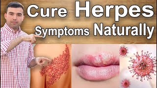 Cure Herpes At Home  How to Heal and Treat Herpes Naturally [upl. by Ynnad]