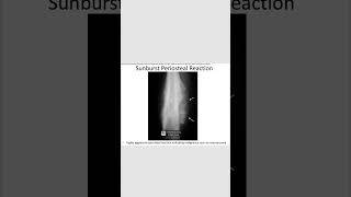 Sunburst periosteal reactionosteosarcoma radiology orthopedics [upl. by Anotyad176]