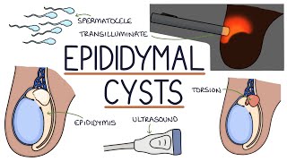 Understanding Epididymal Cysts [upl. by Hsima64]