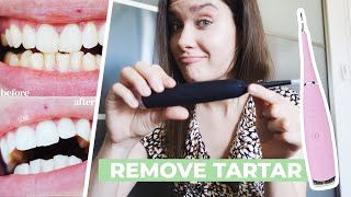 HOW TO REMOVE CALCULUS TARTAR PLAQUE AT HOME  Ultrasonic Tooth Cleaner Review  Does It Work [upl. by Shaia848]