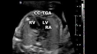 Congenitally corrected transposition of the great arteries [upl. by Eiryt952]