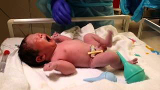 Baby 3 Live Birth in 4K UHD Video Csection Operation Delivery camera recording [upl. by Acyre]