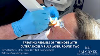 Treating Redness of the Nose with Cutera Excel V Plus Laser Round Two  David Bushore MD [upl. by Eillam]