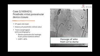 4 challenging cases in a single working day in Cathlab No 8 TAVI Paravalvular ASD and SVC [upl. by Beeson582]