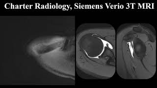 MRI Arthrogram of the Shoulder [upl. by Ettore]