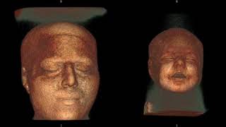 Lissencephal Brain VS normal Brain using MRI [upl. by Alegnad]