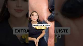 😱 ATENCIÓN ESPECIAL 🚨 para un Quiste Sebáceo 💆‍♀ [upl. by Snodgrass]