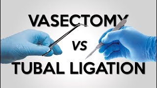 Vasectomy vs Tubal Ligation [upl. by Darahs163]