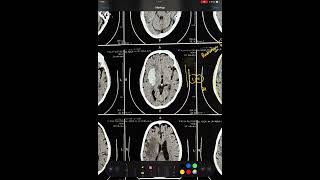 CT BRAIN  PUTAMEN BLEED  BASAL GANGLIA HEMORRHAGE TYPICAL HYPERTENSIVE BLEED HEMORRHAGE [upl. by Erica874]