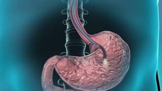 Learn about gastroscopy [upl. by Aiza]