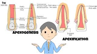 Apexogenesis and Apexification Mastering Endodontic Procedures as a Dental Student [upl. by Aluino]