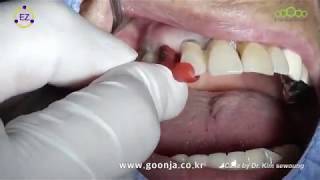 EZ Crown Final Cementation Using Jig [upl. by Tnafni]