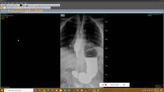 Radiografía de vías digestivas altas esófago estomago duodeno [upl. by Kotz]