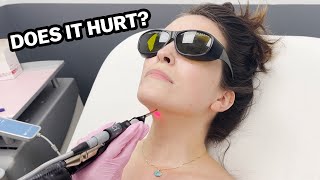 My Journey With Laser Hair Removal The Truth [upl. by Irtimid]