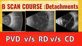 B scan course  differentiate retinal detachment from vitreous detachment and choroidal detachment [upl. by Giliana]