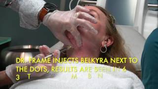 Watch Real Belkyra Injections for Reducing Double Chin Fat [upl. by Ahtamas179]