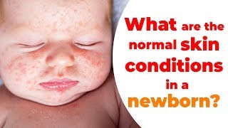 What are the normal skin conditions in a newborn  Dr Pankaj Parekh and Dr Nihar Parekh [upl. by Pessa]