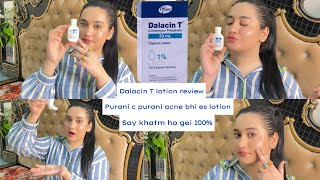 Dalacin T Lotion Review Bye bye Acne 😡 say Hi to new skin❤️Best Acne lotion 100 guaranteed results [upl. by Terrijo]