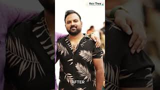 Hairtree Hairtransplant Clinic hairtransformation motivation hairtransplantemikerala [upl. by Nave53]