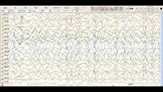 EEG Symptomatic generalized epilepsy [upl. by Nollek]