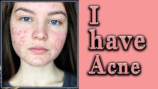 What I Learned from 10 Dermatologists About Acne Treatment [upl. by Morehouse730]