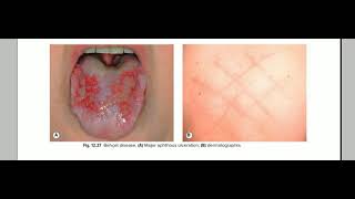 behcet disease [upl. by Akoyn]