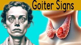 Goiter explained under 3 minutes Causes Symptoms Treatment [upl. by Serle]