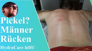 HydraCare Behandlung für Pickel und Juckreiz auf dem Männerrücken  BodyDream Kosmetikstudio [upl. by Toile]