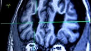 Transorbit lobotomy and MRI examination of living lobotomized patients brain [upl. by Nimrak]