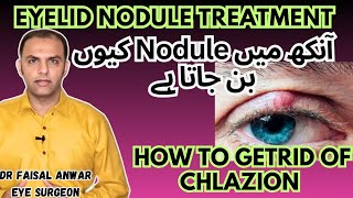 Chlazion  Treatment  Causes and Diagnosis Chlazion Removal drfaisalanwar eyelidnodule Chlazion [upl. by Ninel]