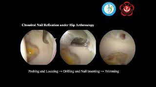 Arthroscopic Repair of Acetabular Cartilage Delamination Using Chondral Nail Fixation in Patients Wi [upl. by Adnohr23]