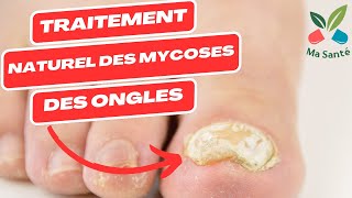 Traitement naturel des mycose  mycose pied  mycose ongle pied  mycose ongle main et les autres [upl. by Blayze]