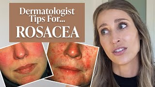 Dermatologist’s Guide to Rosacea What Is It Dos amp Don’ts Treatment Tips amp More  Dr Sam Ellis [upl. by Walters332]