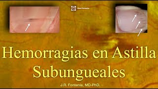 Hemorragias en Astilla Subungueales Endocarditis Bacteriana [upl. by Lussi]