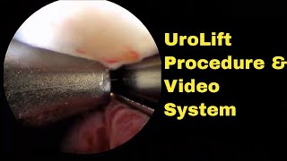 Narrated UroLift Procedure Video as shown using Redfin R3800 Digital Video System for Cystoscopy [upl. by Nananne]