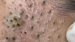 The Ultimate Satisfaction of Blackhead Removal Is Pure Bliss [upl. by Zoi]