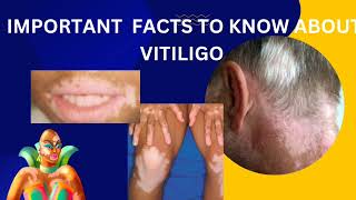 vitiligopart2diagnosis and latest treatment about opzelura creamskinhealthvitality5959 [upl. by Yllah]