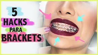 5 HACKS PARA QUIENES TIENEN BRACKETS Carel Quezada [upl. by Oicanata469]