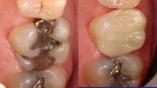 Cosmetic Dentistry Natural 1Visit Porcelain CrownsVeneers [upl. by Thor878]