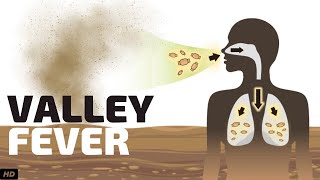 Valley Fever Causes Signs and Symptoms Diagnosis and Treatment [upl. by Hobie]