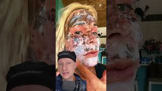 SHOCKING CO2 Laser Recovery Is Normal  Plastic Surgeon Reacts [upl. by Buskus]