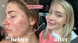 MY FULL ACCUTANE JOURNEY  side effects cost will it come back [upl. by Otilopih261]