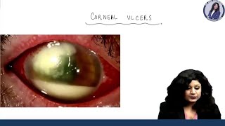 Corneal Ulcers  Dr Niha Aggarwal [upl. by Noryahs869]