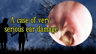 In case of serious ear damage Ear fungus ear infection perforated eardrum [upl. by Sone]