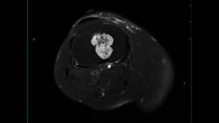 Enchondroma Tibia [upl. by Volny361]