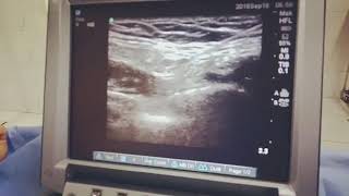 US guided genitofemoral nerve block [upl. by Yvaht418]