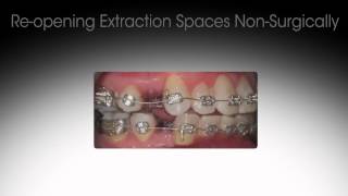 Reversing Previous Orthodontic Treatment [upl. by Acino]