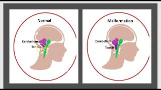 La Syringomyélie Malformation dArdnold Chiari LHydrocéphalie Maladie du Filum Syrinx Traitement 3m [upl. by Muriah]