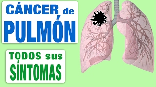 Todos Los Síntomas del Cáncer de Pulmón [upl. by Bettina]